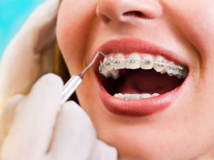Dental-Braces-cost-in-india